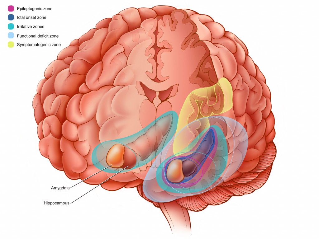 Color illustration showing an epileptic network. Regions of the brain affected by reoccuring seizures. Regions labeled with colors and a color key is in the upper left corner.