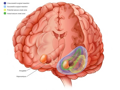 Color illustration of brain with surgical options shown as color labels. Color key in the upper left corner.