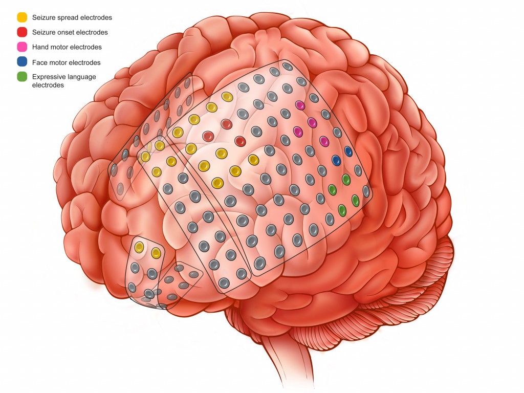 Color illustration of brain with subdural electrodes on the surface for monitoring patient with epilepsy. Color key in upper left for electrodes.
